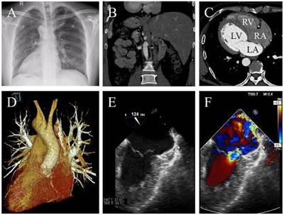 Case Report: The Cox-Maze IV Procedure in the Mirror: The Use of Three-Dimensional Printing for Pre-operative Planning in a Patient With Situs Inversus Dextrocardia